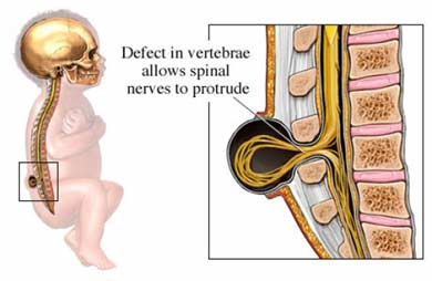 Spina bifida.jpg